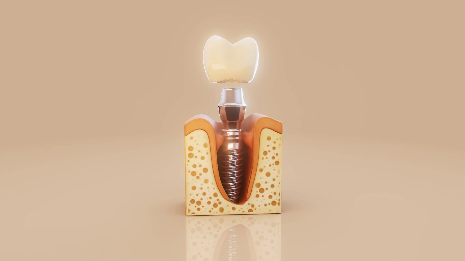 Dental Implants 2 Dental implant