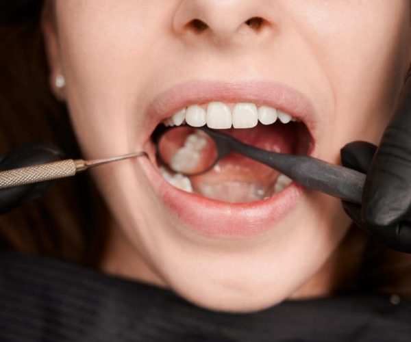 root canal dulo dent